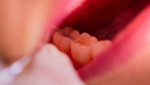 Zahnarzt bohrt versehentlich Schraube in Gehirn von Patient