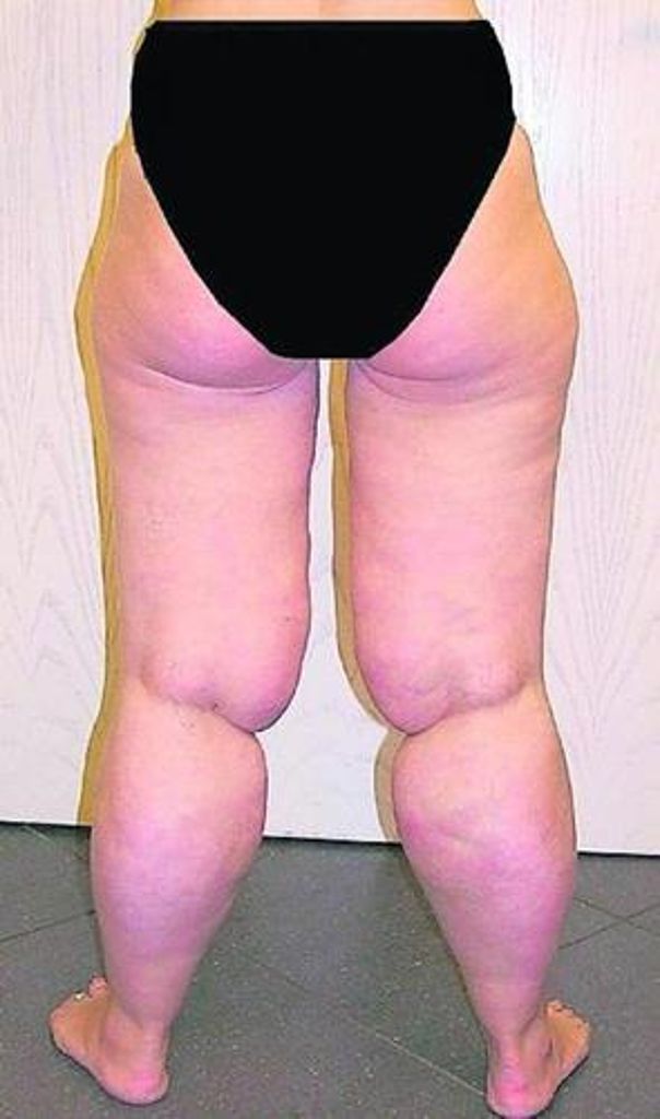 Frauen, deren Beine und Po so aussehen, sind oft nicht einfach zu dick, sondern leiden unter einem Lipödem.